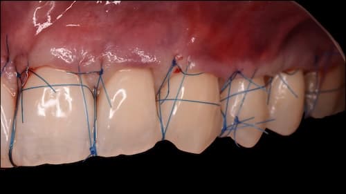 Chirurgie muco-gingivale : du diagnostic étiologique au geste reproductible