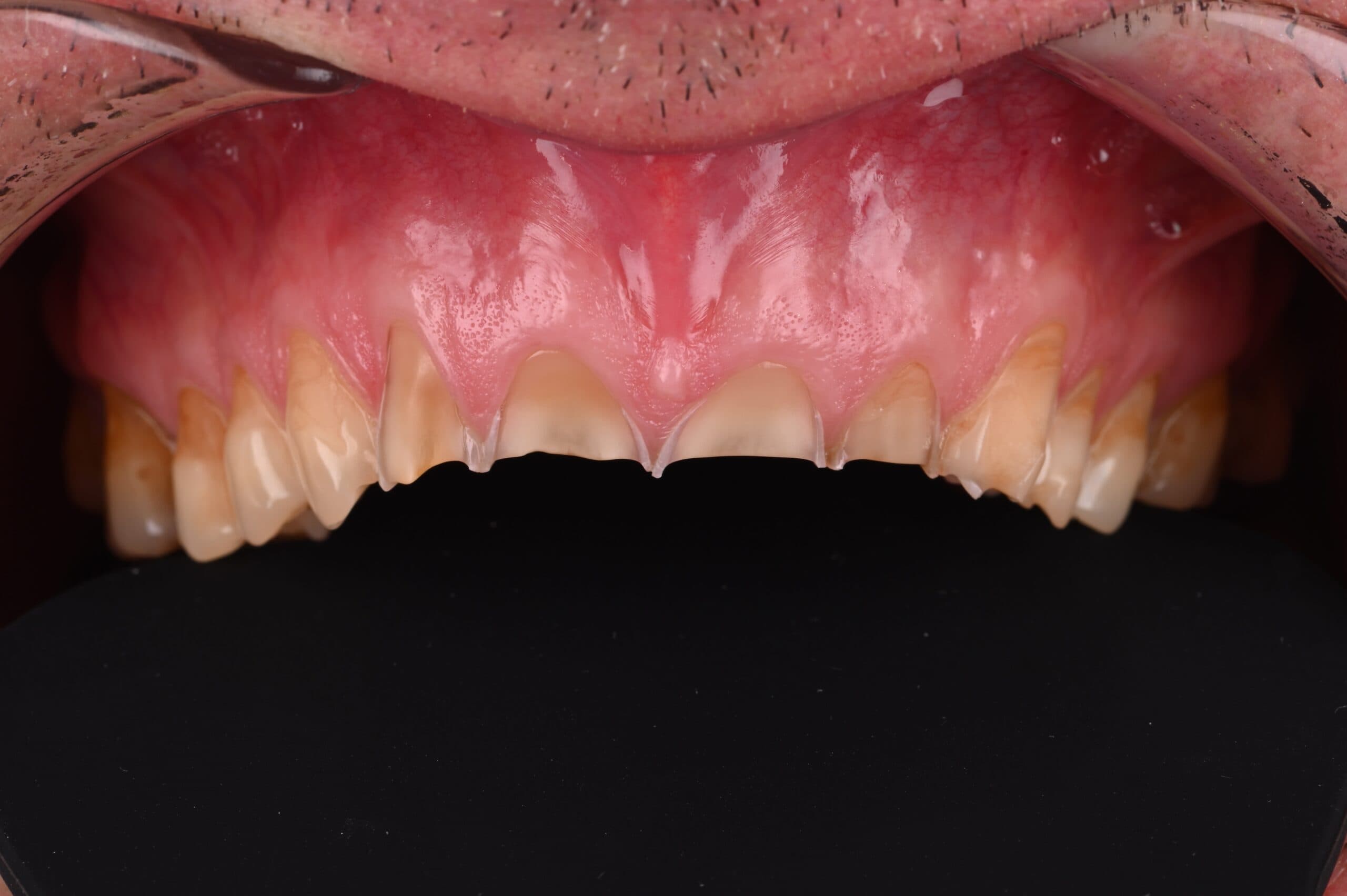 Les usures dentaires — Dr Franck Moyal (Smile Club)