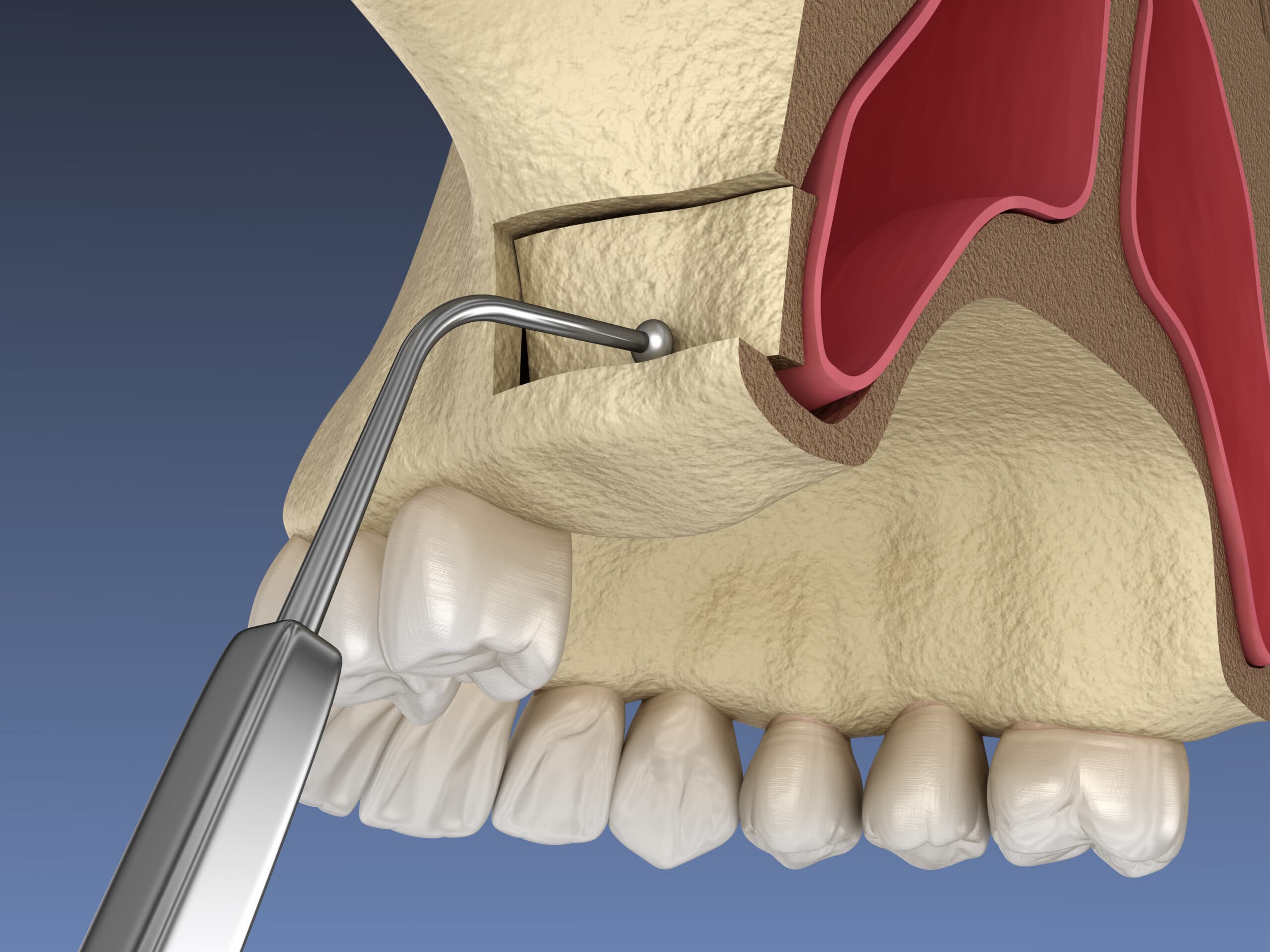 Chirurgiens-dentistes : Nos 5 conseils pour réussir votre Sinus Lift